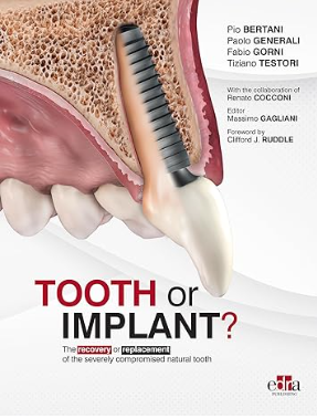 Tooth or Implant?: The recovery or replacement of the severely compromised natural tooth