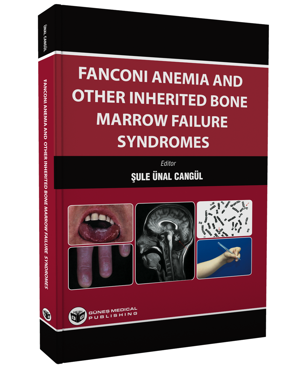 Fanconi Anemia And Other Inherited Bone Marrow Failure Syndromes